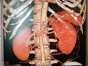 CT(Computed Tomography)検査